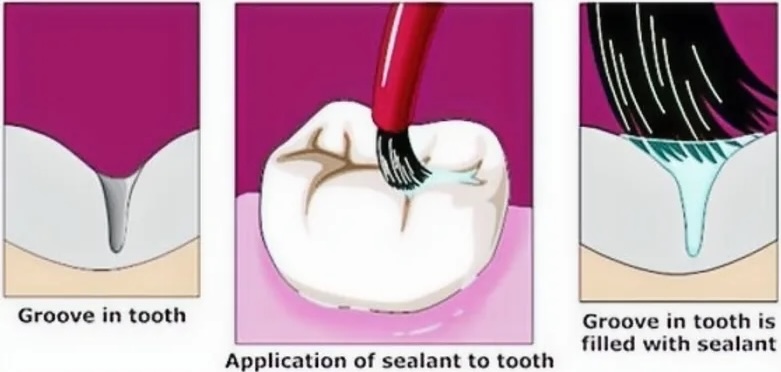Sealants