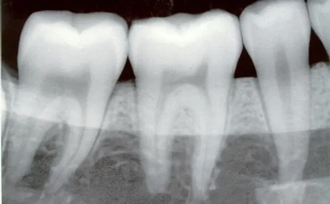 X-rays