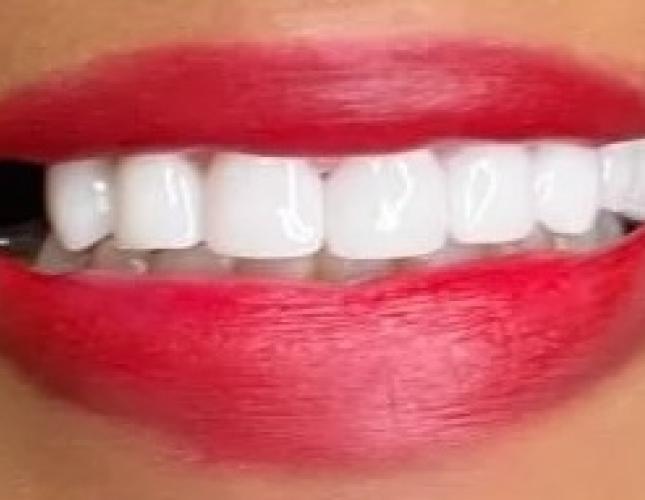 Case 1 after