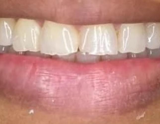 Case 1 before
