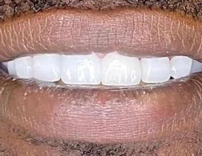 Case 5 after
